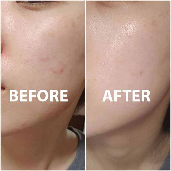 Trước và sau khi sử dụng kem chống nắng Skin1004 Centella